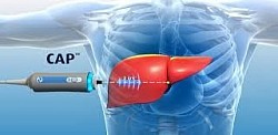 fibroscan in changanacherry