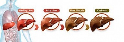 fibroscan